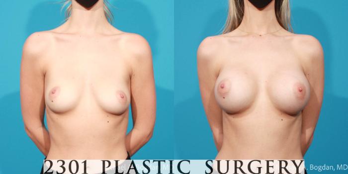 Before & After Breast Augmentation Case 682 Front View in Fort Worth, Plano, & Frisco, Texas