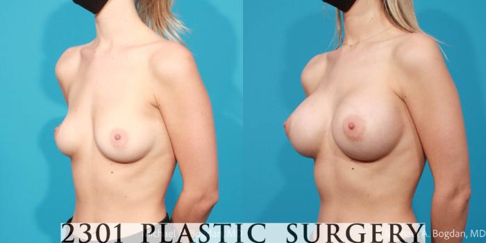 Before & After Breast Augmentation Case 682 Left Oblique View in Fort Worth, Plano, & Frisco, Texas