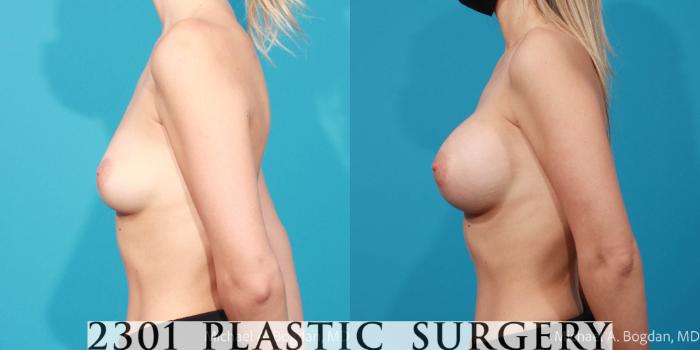 Before & After Silicone Implants Case 682 Left Side View in Fort Worth, Plano, & Frisco, Texas