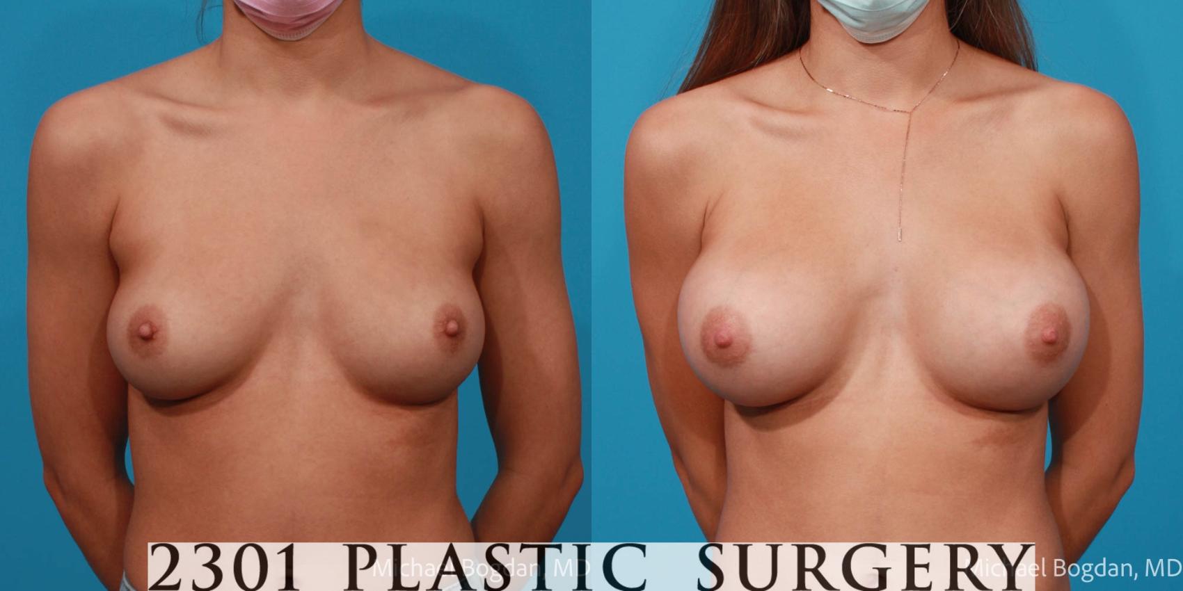 Before & After Breast Augmentation Case 683 Front View in Fort Worth & Frisco, Texas