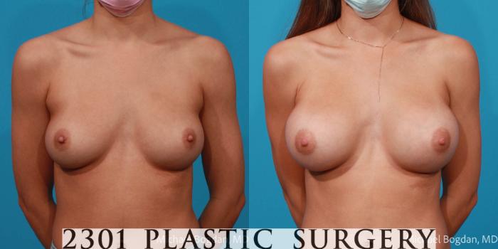 Before & After Saline Implants Case 683 Front View in Fort Worth, Plano, & Frisco, Texas