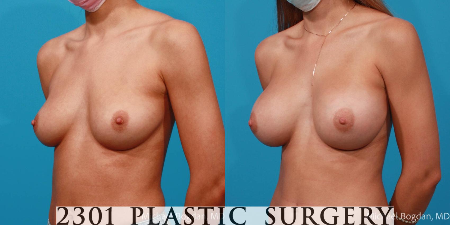 Before & After Breast Augmentation Case 683 Left Oblique View in Fort Worth & Frisco, Texas