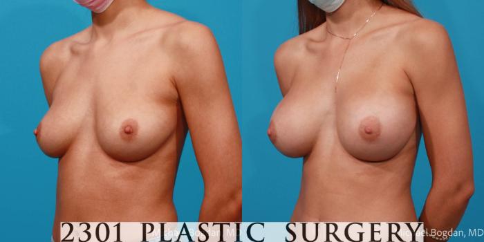 Before & After Saline Implants Case 683 Left Oblique View in Fort Worth, Plano, & Frisco, Texas