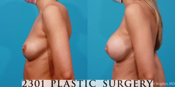 Before & After Saline Implants Case 683 Left Side View in Fort Worth, Plano, & Frisco, Texas