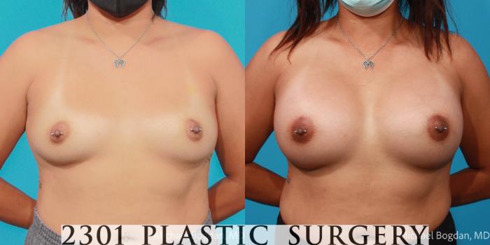 Before & After Silicone Implants Case 687 Front View in Fort Worth, Plano, & Frisco, Texas