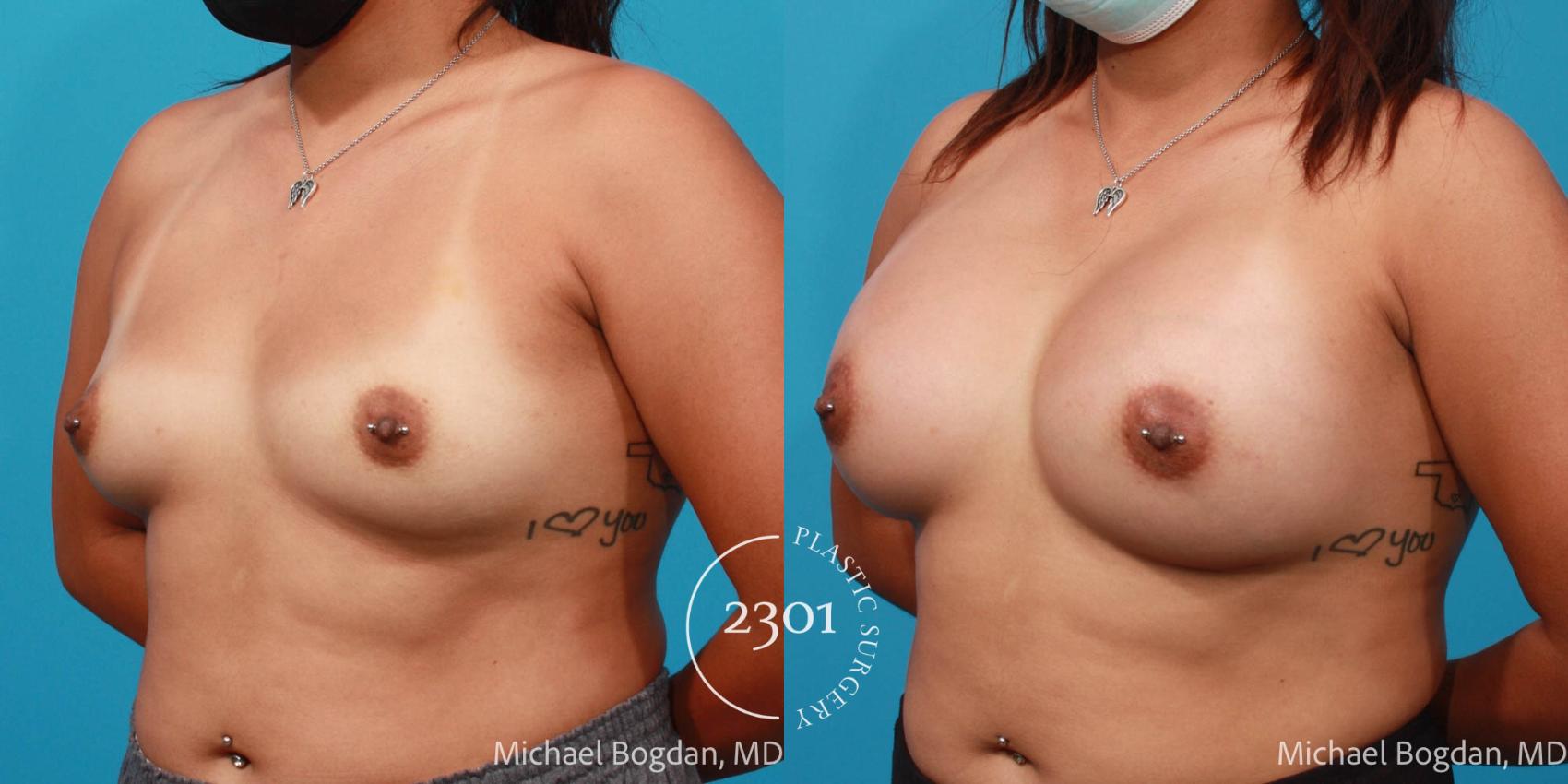 Before & After Silicone Implants Case 687 Left Oblique View in Fort Worth, Plano, & Frisco, Texas