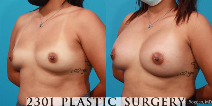 Before & After Breast Augmentation Case 687 Left Oblique View in Fort Worth, Plano, & Frisco, Texas
