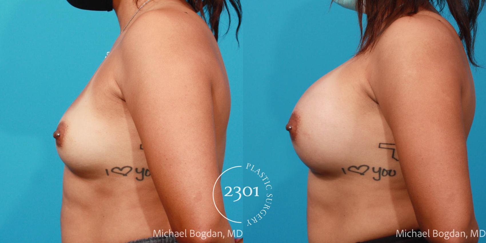 Before & After Silicone Implants Case 687 Left Side View in Fort Worth, Plano, & Frisco, Texas