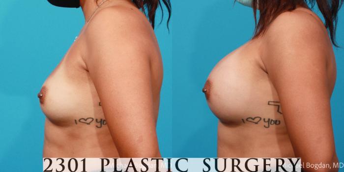 Before & After Silicone Implants Case 687 Left Side View in Fort Worth, Plano, & Frisco, Texas