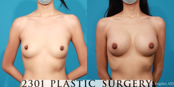Before & After Breast Augmentation Case 688 Front View in Fort Worth, Plano, & Frisco, Texas