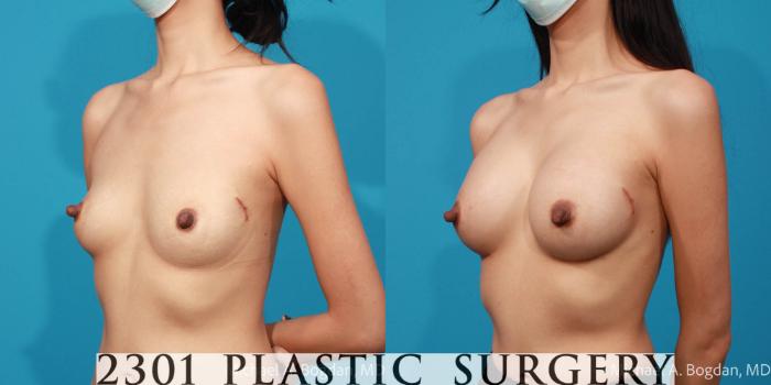 Before & After Breast Augmentation Case 688 Left Oblique View in Fort Worth, Plano, & Frisco, Texas