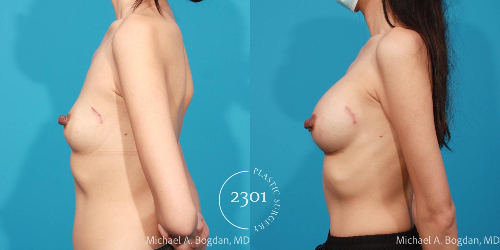 Before & After Breast Augmentation Case 688 Left Side View in Fort Worth, Plano, & Frisco, Texas