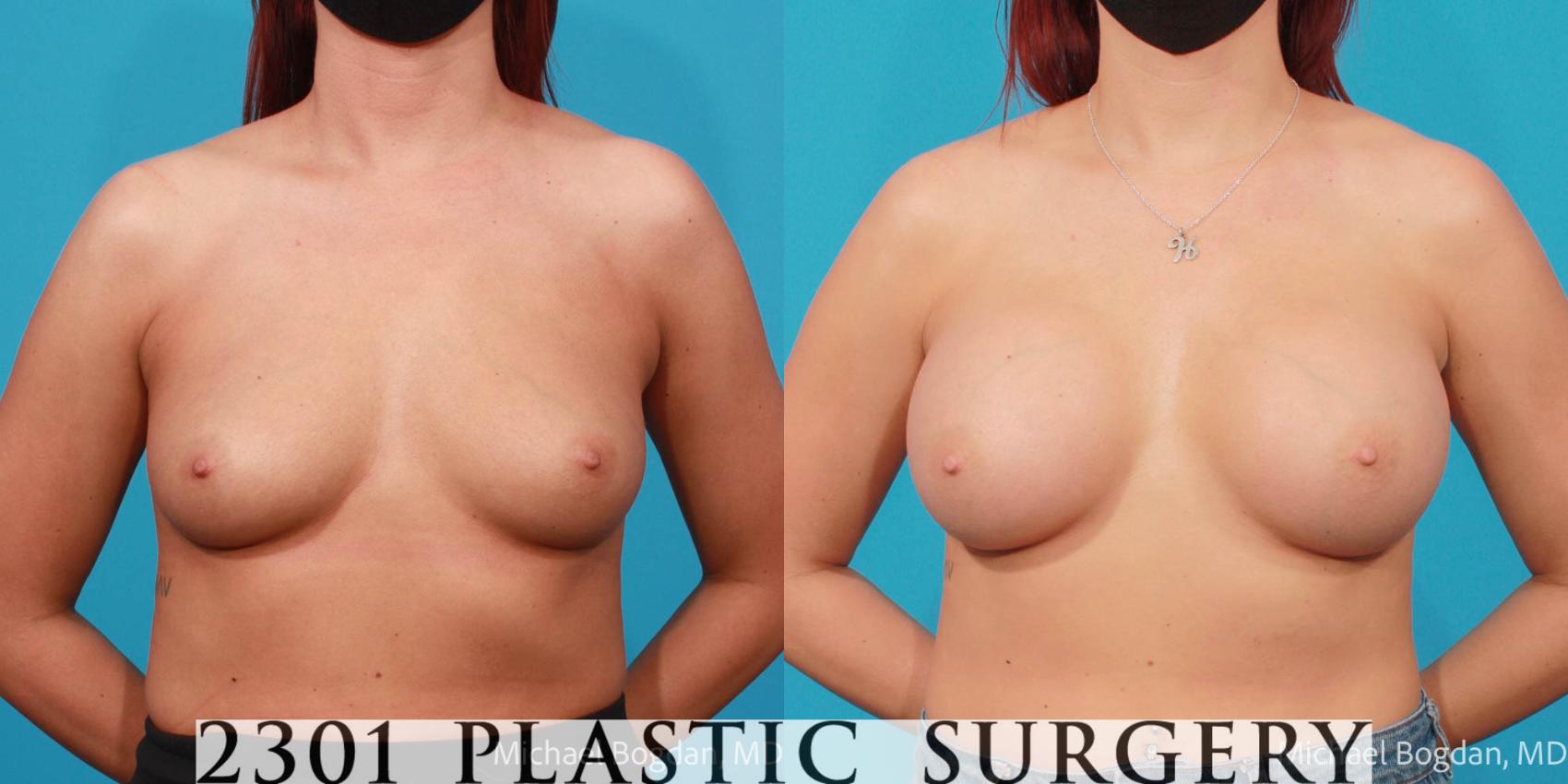 Before & After Breast Augmentation Case 692 Front View in Fort Worth, Plano, & Frisco, Texas