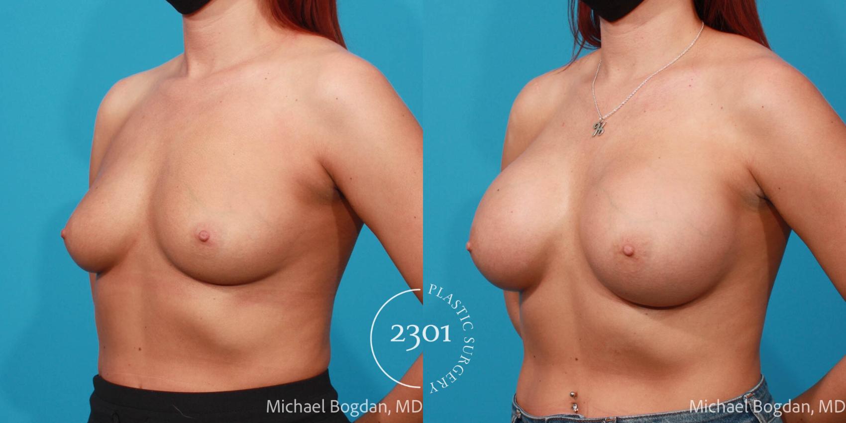 Before & After Breast Augmentation Case 692 Left Oblique View in Fort Worth, Plano, & Frisco, Texas
