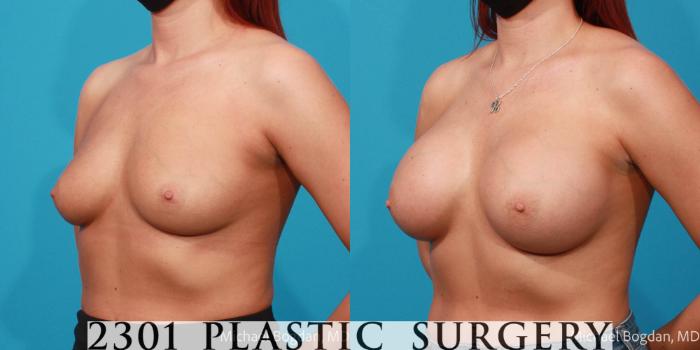 Before & After Breast Augmentation Case 692 Left Oblique View in Fort Worth, Plano, & Frisco, Texas