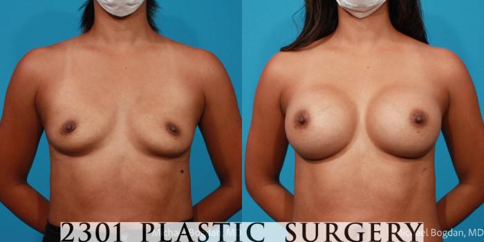 Before & After Silicone Implants Case 696 Front View in Fort Worth, Plano, & Frisco, Texas