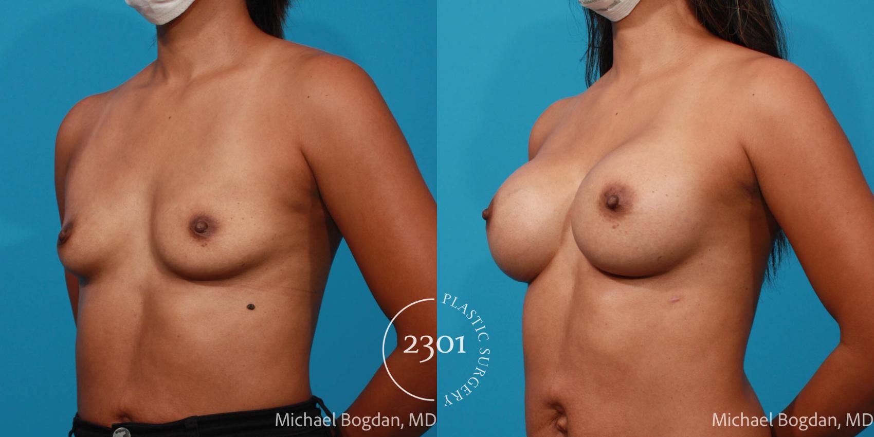 Before & After Silicone Implants Case 696 Left Oblique View in Fort Worth, Plano, & Frisco, Texas