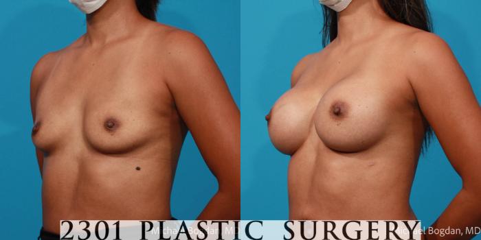 Before & After Silicone Implants Case 696 Left Oblique View in Fort Worth, Plano, & Frisco, Texas