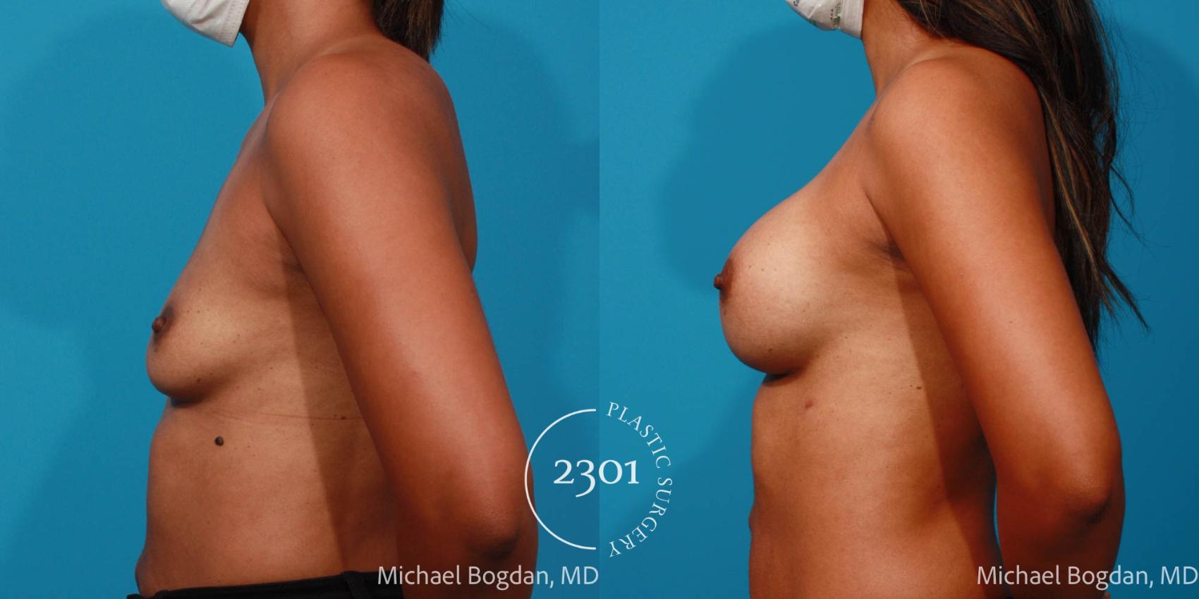 Before & After Silicone Implants Case 696 Left Side View in Fort Worth, Plano, & Frisco, Texas