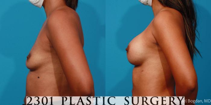 Before & After Breast Augmentation Case 696 Left Side View in Fort Worth, Plano, & Frisco, Texas