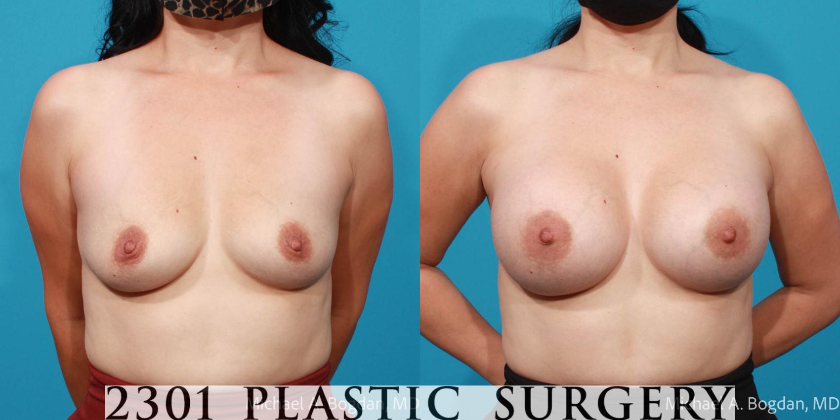 Before & After Breast Augmentation Case 698 Front View in Fort Worth, Plano, & Frisco, Texas