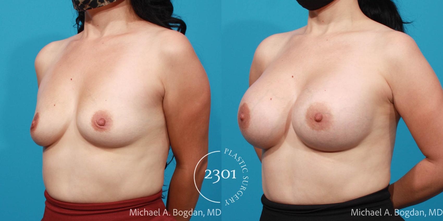 Before & After Breast Augmentation Case 698 Left Oblique View in Fort Worth, Plano, & Frisco, Texas