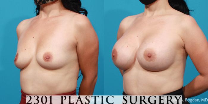 Before & After Breast Augmentation Case 698 Left Oblique View in Fort Worth, Plano, & Frisco, Texas