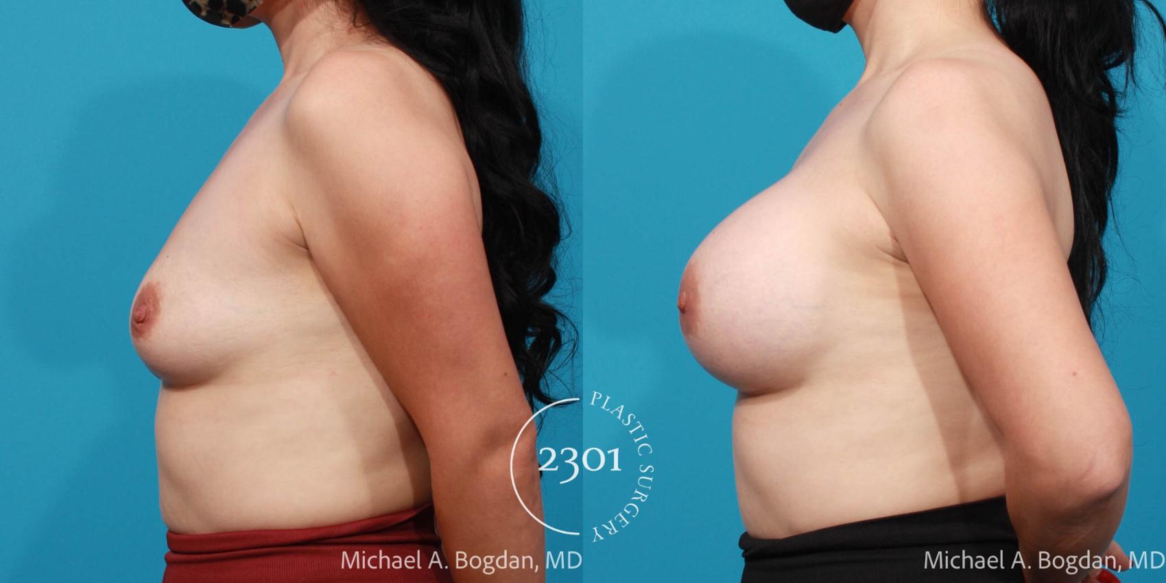 Before & After Breast Augmentation Case 698 Left Side View in Fort Worth, Plano, & Frisco, Texas