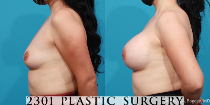 Before & After Silicone Implants Case 698 Left Side View in Fort Worth, Plano, & Frisco, Texas