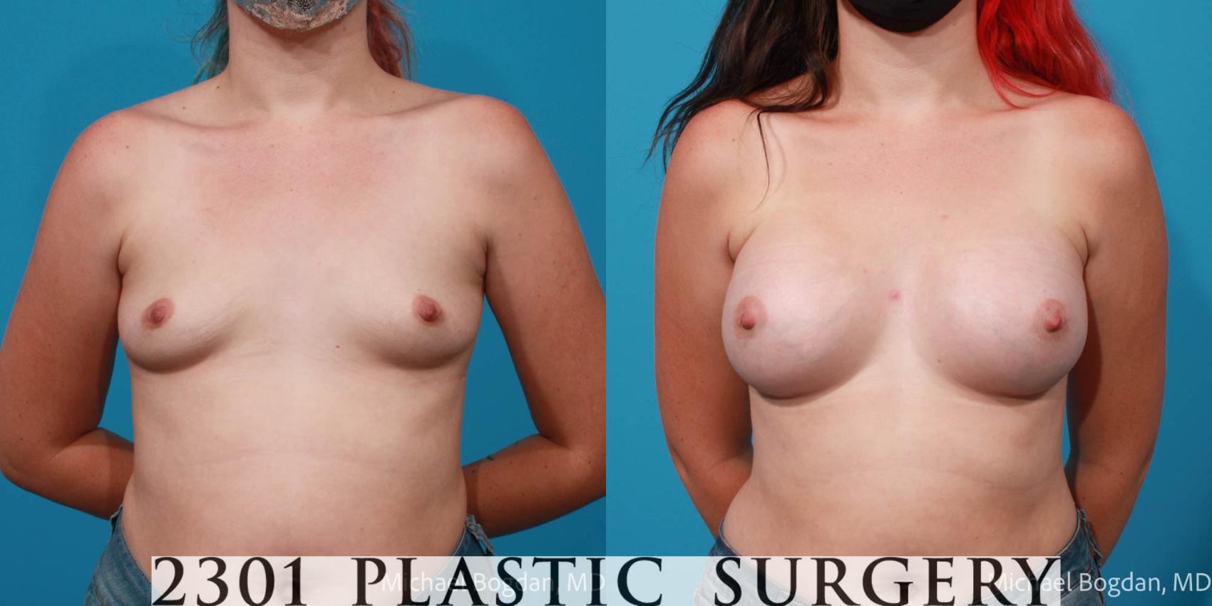 Before & After Silicone Implants Case 705 Front View in Fort Worth, Plano, & Frisco, Texas