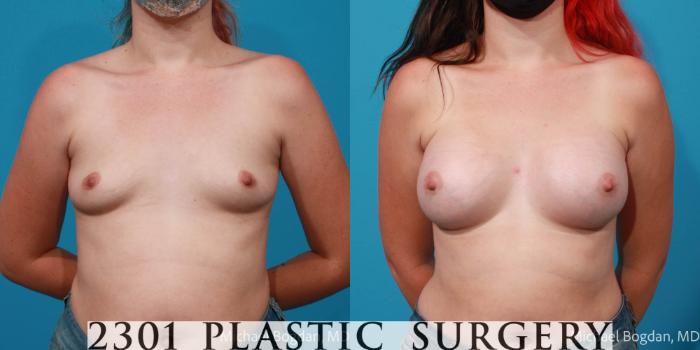 Before & After Silicone Implants Case 705 Front View in Fort Worth, Plano, & Frisco, Texas