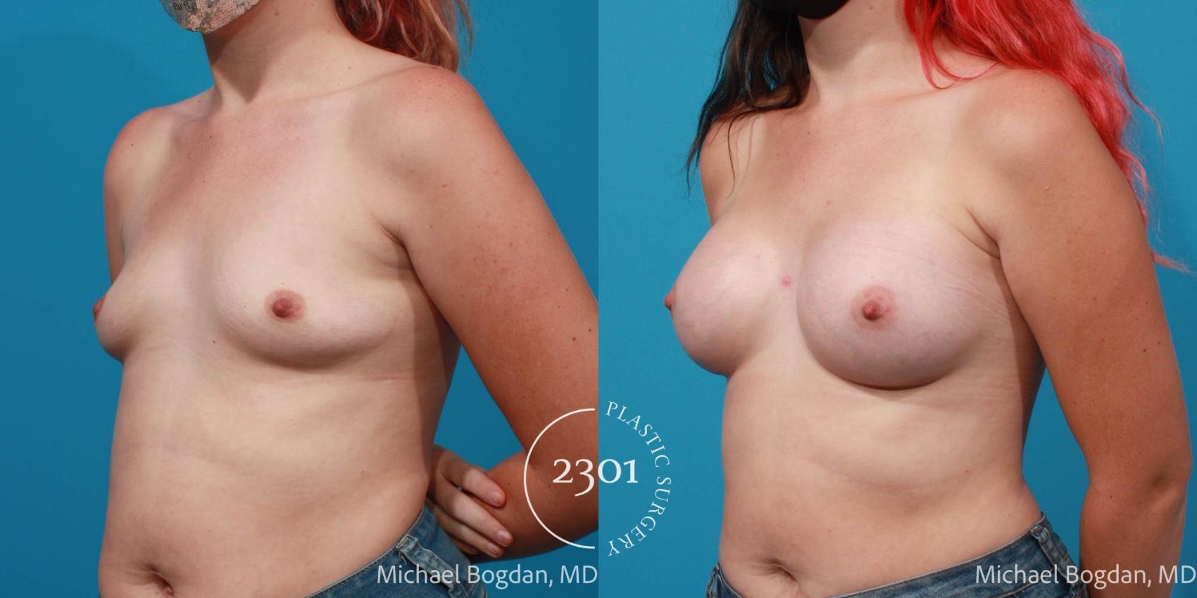 Before & After Breast Augmentation Case 705 Left Oblique View in Fort Worth, Plano, & Frisco, Texas