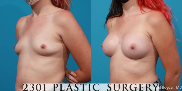Before & After Breast Augmentation Case 705 Left Oblique View in Fort Worth, Plano, & Frisco, Texas