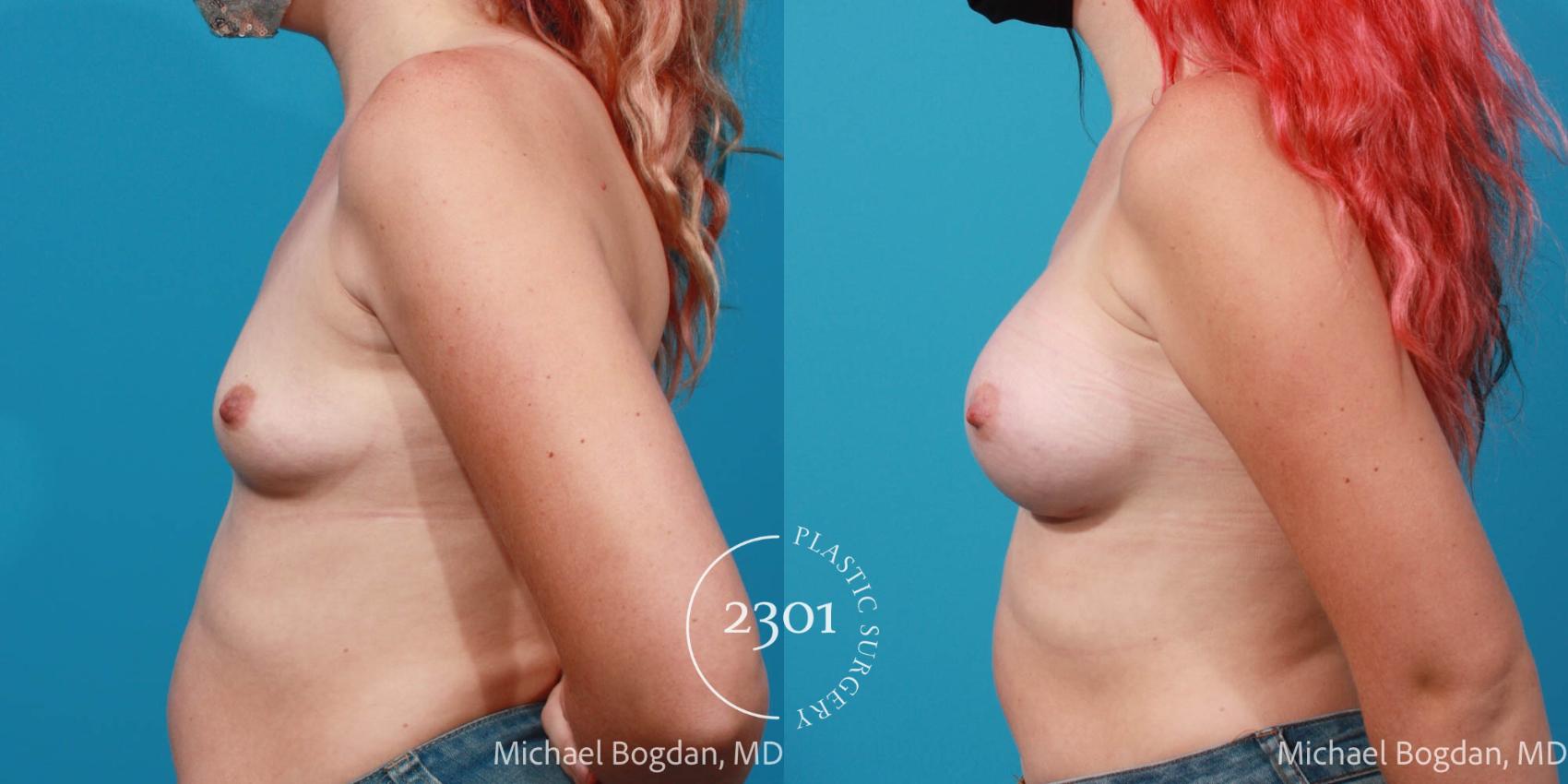 Before & After Breast Augmentation Case 705 Left Side View in Fort Worth, Plano, & Frisco, Texas