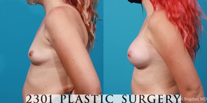 Before & After Breast Augmentation Case 705 Left Side View in Fort Worth, Plano, & Frisco, Texas