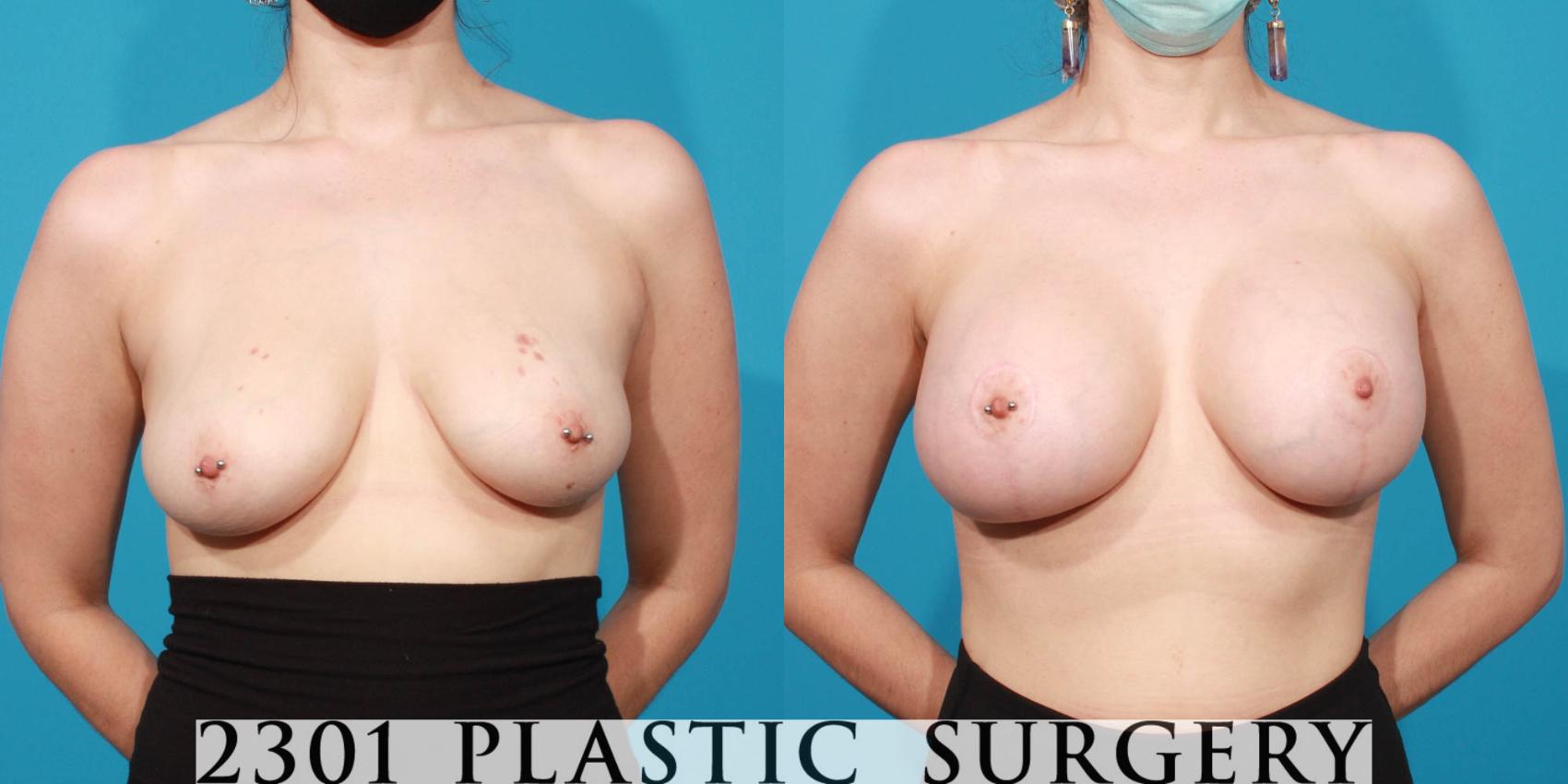 Before & After Silicone Implants Case 714 Front View in Fort Worth & Frisco, Texas