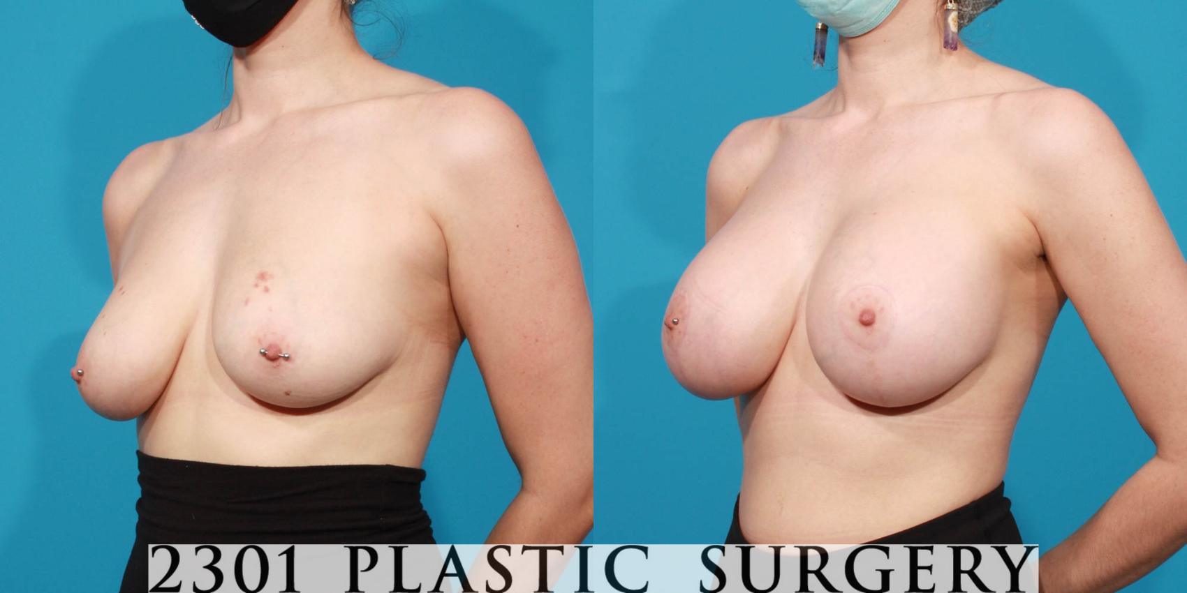 Before & After Silicone Implants Case 714 Left Oblique View in Fort Worth & Frisco, Texas