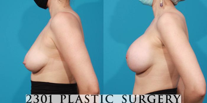 Before & After Silicone Implants Case 714 Left Side View in Fort Worth, Plano, & Frisco, Texas