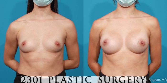 Before & After Breast Augmentation Case 715 Front View in Fort Worth, Plano, & Frisco, Texas