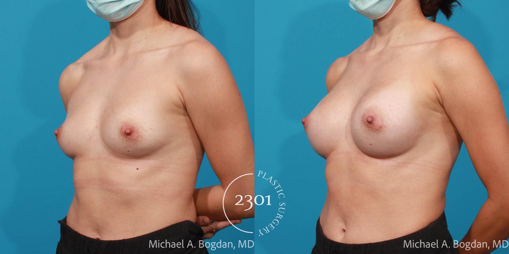 Before & After Breast Augmentation Case 715 Left Oblique View in Fort Worth, Plano, & Frisco, Texas