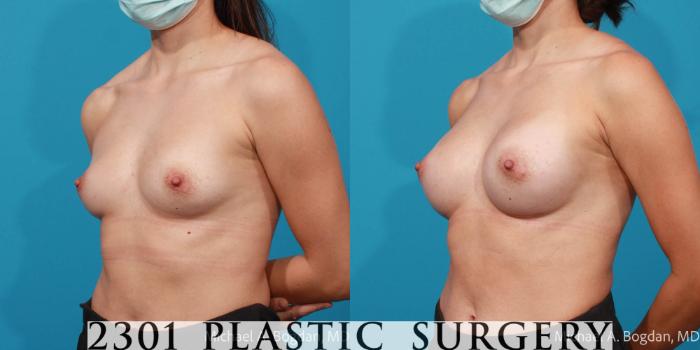 Before & After Breast Augmentation Case 715 Left Oblique View in Fort Worth, Plano, & Frisco, Texas