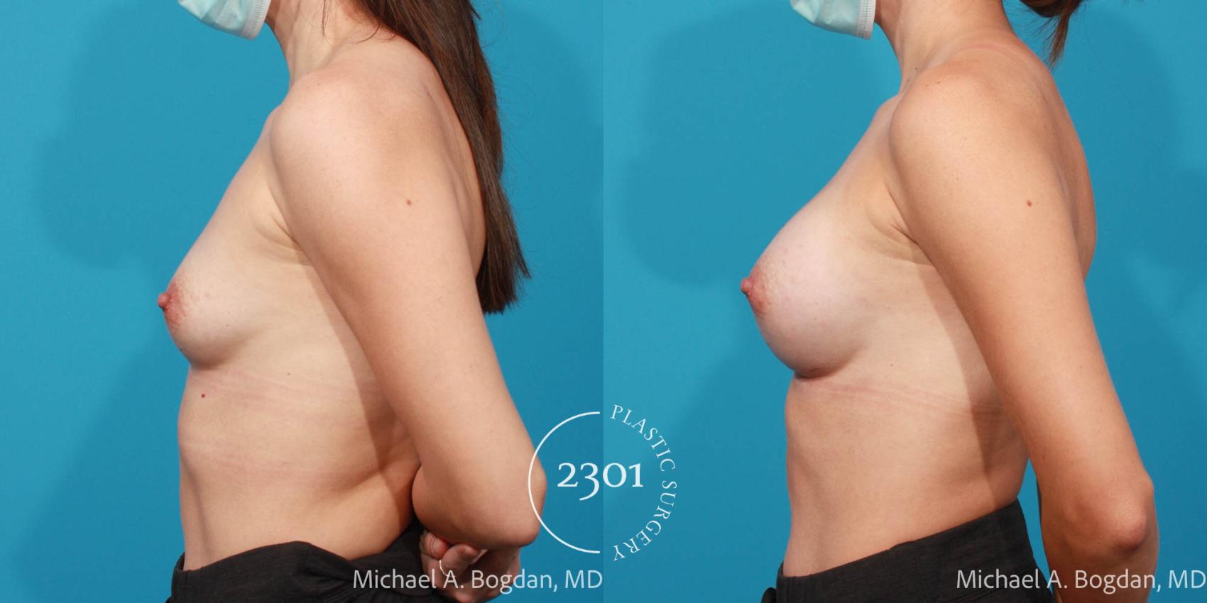 Before & After Breast Augmentation Case 715 Left Side View in Fort Worth, Plano, & Frisco, Texas