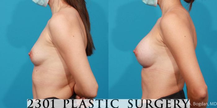 Before & After Breast Augmentation Case 715 Left Side View in Fort Worth, Plano, & Frisco, Texas