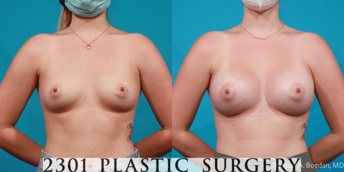 Before & After Silicone Implants Case 718 Front View in Fort Worth, Plano, & Frisco, Texas