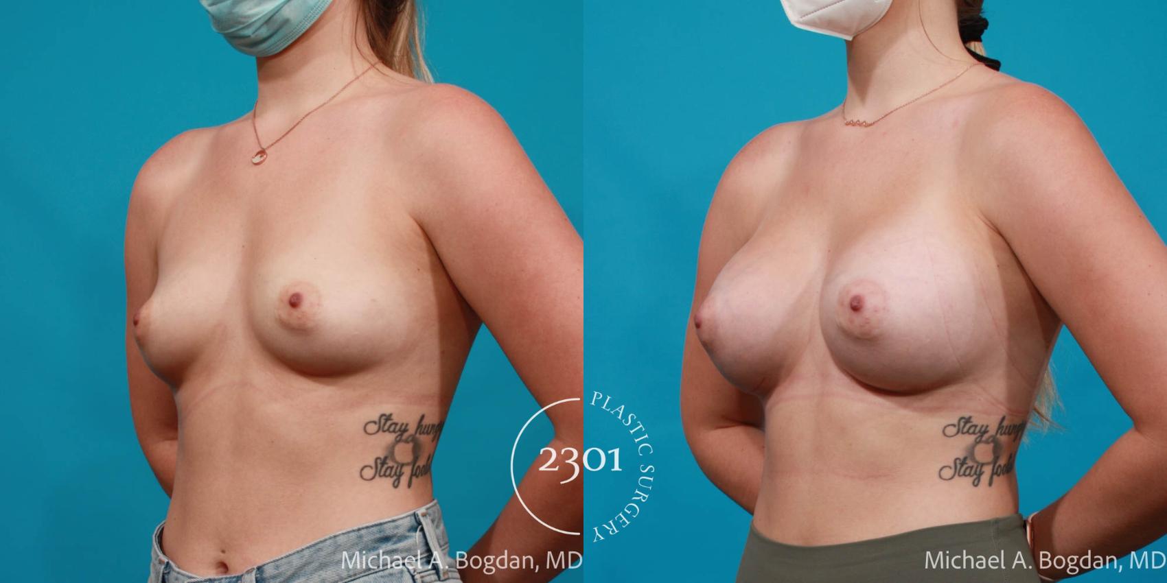 Before & After Silicone Implants Case 718 Left Oblique View in Fort Worth, Plano, & Frisco, Texas