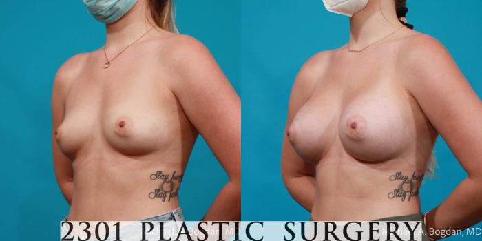 Before & After Breast Augmentation Case 718 Left Oblique View in Fort Worth, Plano, & Frisco, Texas