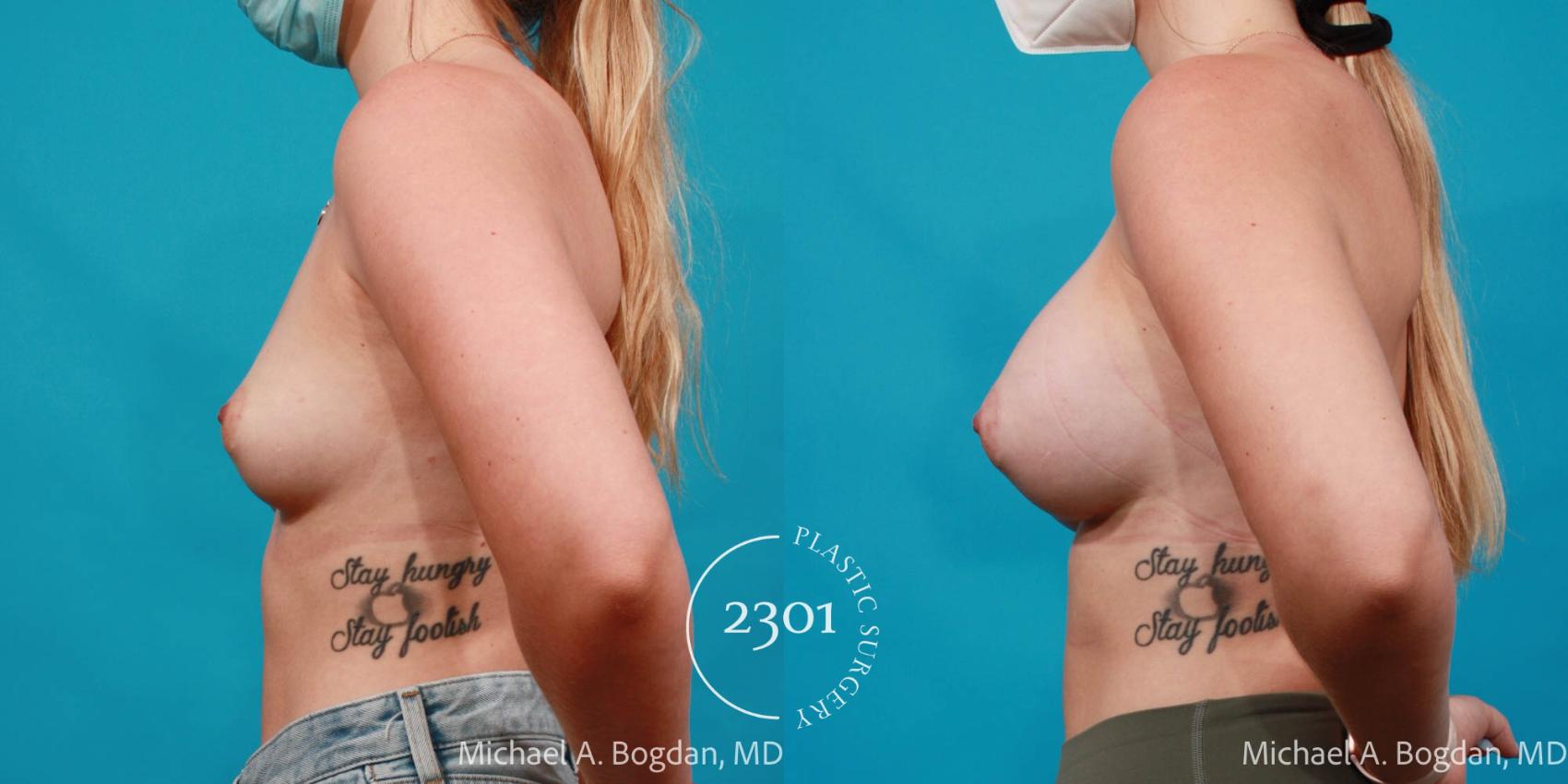 Before & After Silicone Implants Case 718 Left Side View in Fort Worth, Plano, & Frisco, Texas
