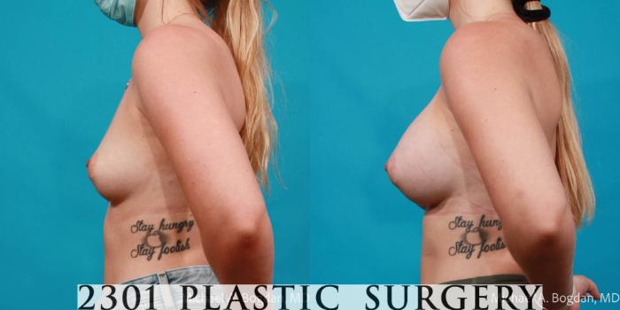 Before & After Silicone Implants Case 718 Left Side View in Fort Worth, Plano, & Frisco, Texas