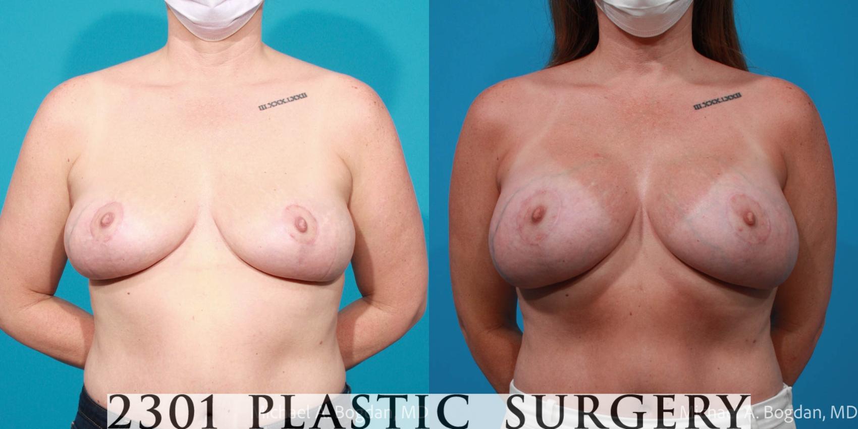 Before & After Breast Augmentation Case 720 Front View in Fort Worth, Plano, & Frisco, Texas