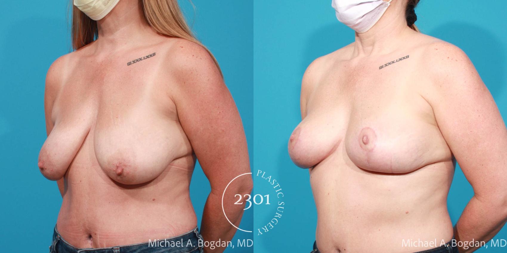 Before & After Silicone Implants Case 720 Left Oblique View in Fort Worth, Plano, & Frisco, Texas